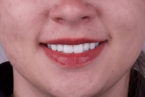 Clareamento Dental